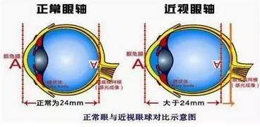 近視眼球突出？！控制近視度數(shù)加深是關(guān)鍵！