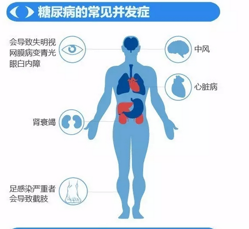 你造嗎？糖尿病晚期眼睛會致盲！