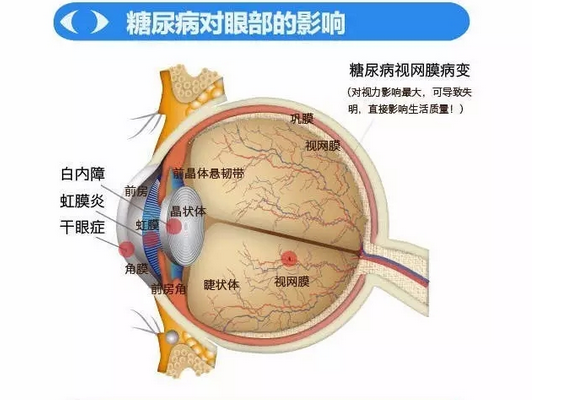 你造嗎？糖尿病晚期眼睛會致盲！