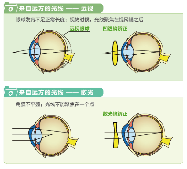 【看圖解】一張圖教你看懂近視、遠(yuǎn)視和散光