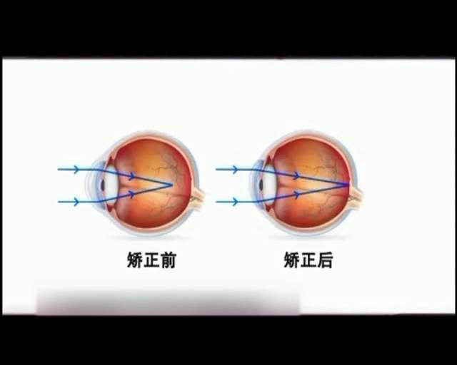 一夜之間真的能改變視力嗎？