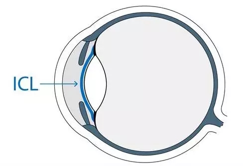 想做ICL晶體植入術，你需要了解的全在這里!